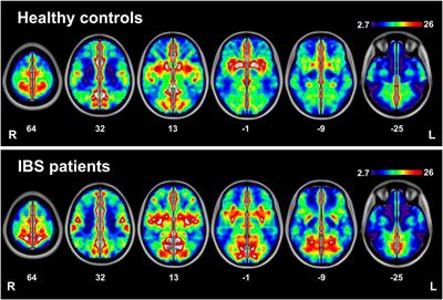 Disturbed Interhemispheric Functional Connectivity Rather than Structural Connectivity in Irritable Bowel Syndrome